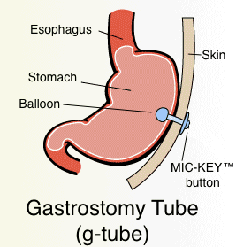 stomach cross section showing g-tube placement